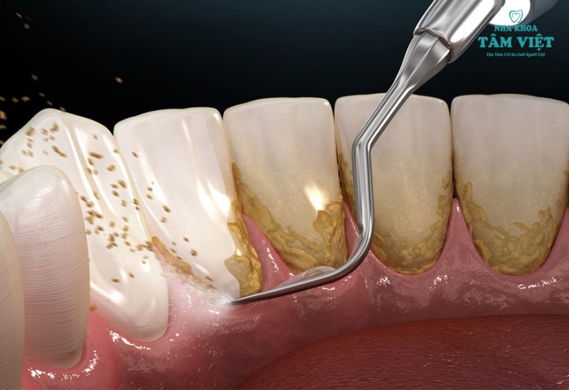 Địa chỉ cạo vôi răng TPHCM uy tín, chuyên nghiệp 2 Vôi răng - Mầm mống của nhiều bệnh răng miệng