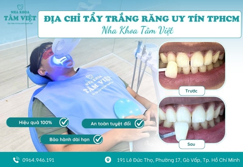 Địa chỉ tẩy trắng răng uy tín, chi phí rẻ tại TPHCM
