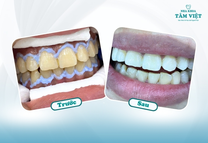 Quy trình tẩy trắng an toàn, chuẩn quốc tế