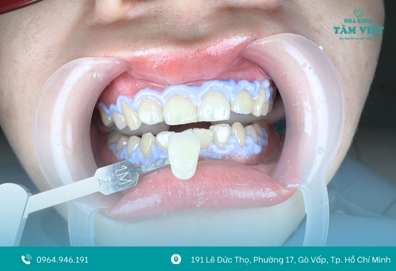 Tiêu chí chọn địa chỉ tẩy trắng răng uy tín tại TPHCM