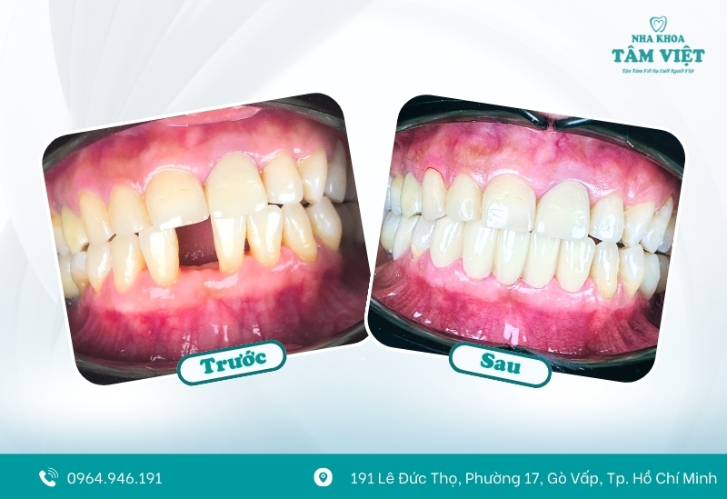 Răng sứ nhập khẩu chính hãng, có bảo hành