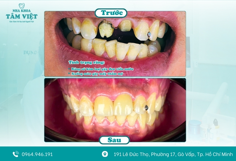 Làm răng sứ trả góp TPHCM 0% lãi suất là cơ hội thiết thực cho mọi người