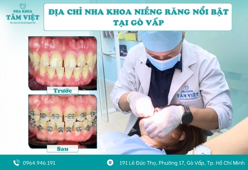 Nên đeo hàm duy trì bao lâu sau khi tháo niềng? 8 Địa chỉ niềng răng uy tín tại TPHCM