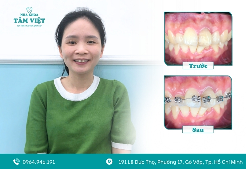 Nên đeo hàm duy trì bao lâu sau khi tháo niềng? 5 Thói quen xấu khiến răng dễ bị dịch chuyển lại