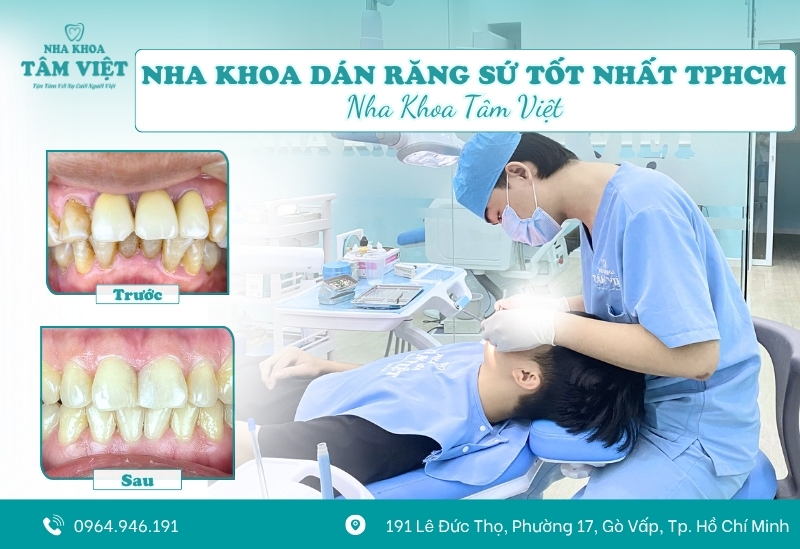 Review nha khoa dán răng sứ tốt nhất TPHCM hiện nay