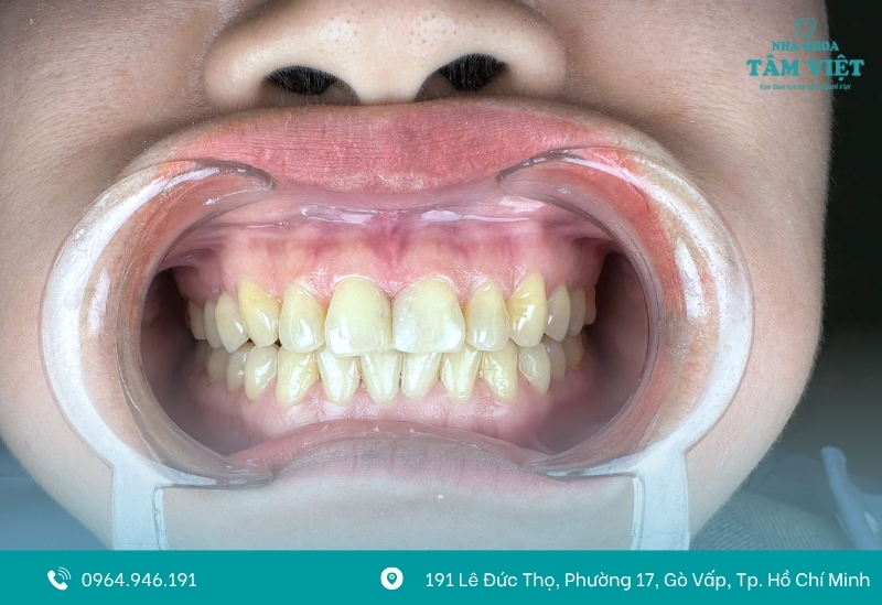 Review nha khoa dán răng sứ tốt nhất TPHCM hiện nay 7 Dán sứ veneer giá bao nhiêu 1 răng?