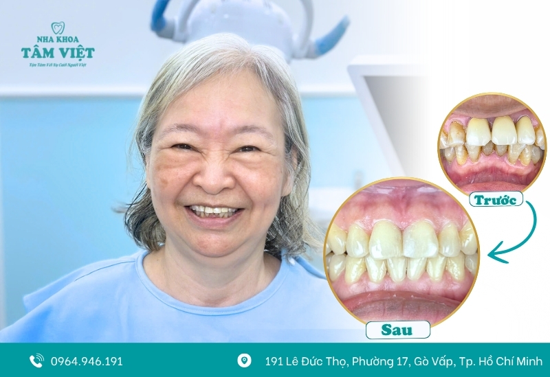 Review nha khoa dán răng sứ tốt nhất TPHCM hiện nay 6 Hình ảnh khách hàng dán sứ veneer tại Tâm Việt