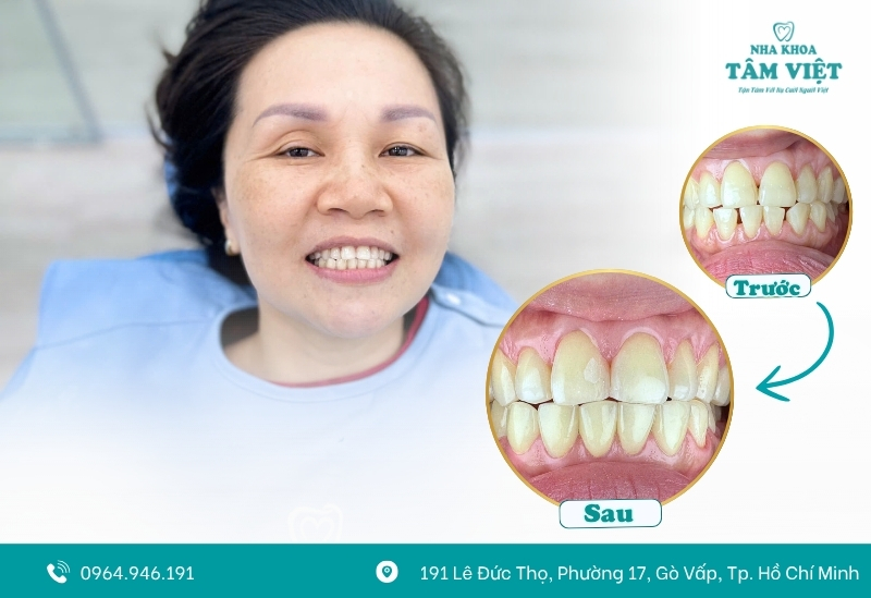 Review nha khoa dán răng sứ tốt nhất TPHCM hiện nay 2 Dán sứ veneer đang dần trở thành xu hướng