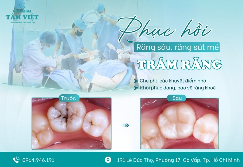 Nha khoa trám răng gần đây chất lượng, chi phí rẻ 2 Trám răng - Giải pháp tối ưu cho nhiều vấn đề răng miệng