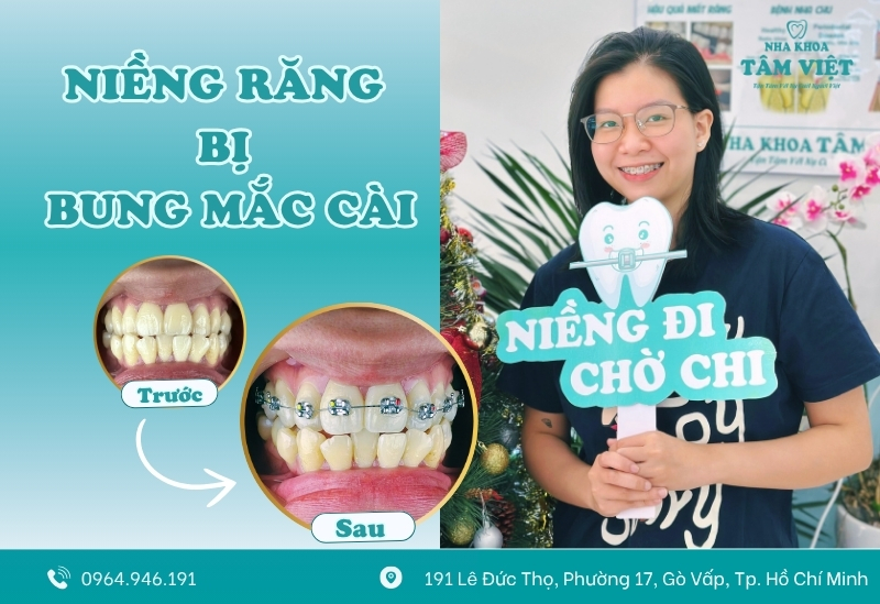 Niềng răng bị bung mắc cài: Nguyên nhân và cách xử lý
