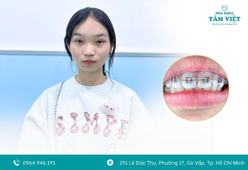Niềng răng bị bung mắc cài: Nguyên nhân và cách xử lý 5 Tình trạng niềng răng bị bung mắc cài không quá nguy hiểm