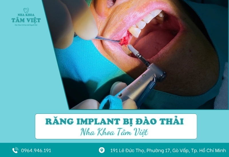 Răng implant bị đào thải: Nguyên nhân, dấu hiệu và cách xử lý