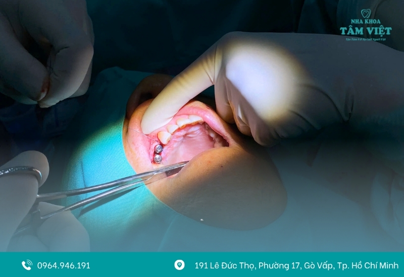 Răng implant bị đào thải: Nguyên nhân, dấu hiệu và cách xử lý 2 Răng implant bị đào thải là gì?