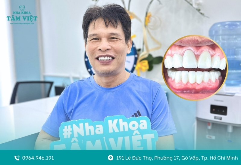 Bọc răng sứ bị hở chân răng phải xử lý như thế nào? 2 Tình trạng răng sứ bị hở chân răng là gì?