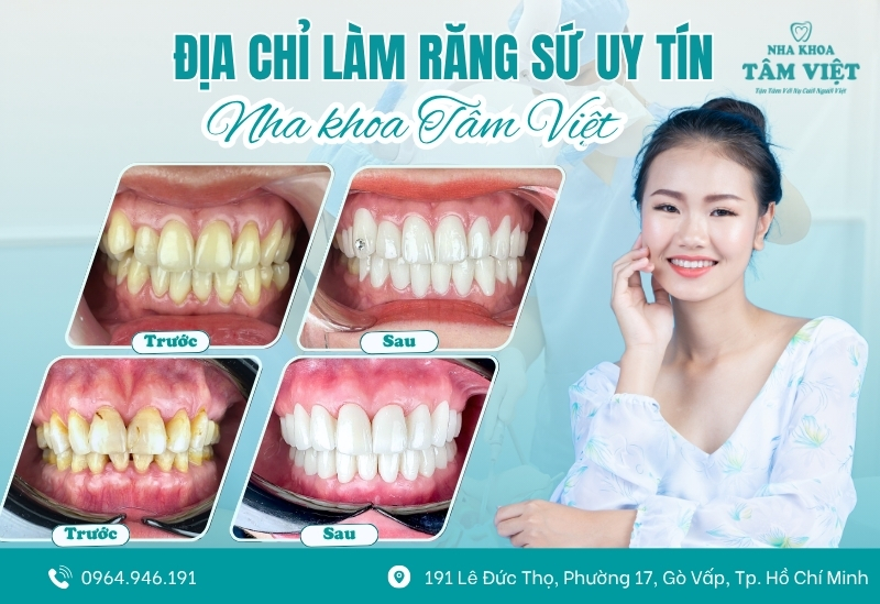 Bọc răng sứ bị hở chân răng phải xử lý như thế nào? 7 Nha khoa Tâm Việt – Địa chỉ bọc răng sứ tốt nhất tại Gò Vấp