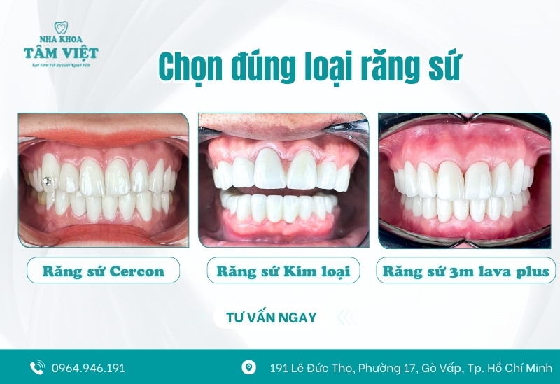 Răng sứ có bị xuống màu theo thời gian không? 3 Chất liệu răng sứ ảnh hưởng trực tiếp màu sắc