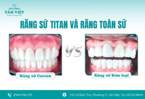 So sánh răng sứ Titan và răng toàn sứ? Có gì khác biệt?