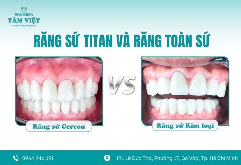 So sánh răng sứ Titan và răng toàn sứ? Có gì khác biệt?