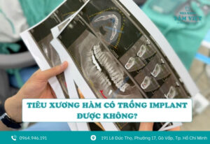 Tiêu xương hàm có trồng implant được không? Lưu ý quan trọng