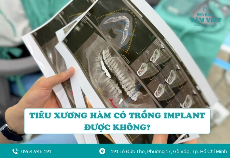 Tiêu xương hàm có trồng implant được không? Lưu ý quan trọng