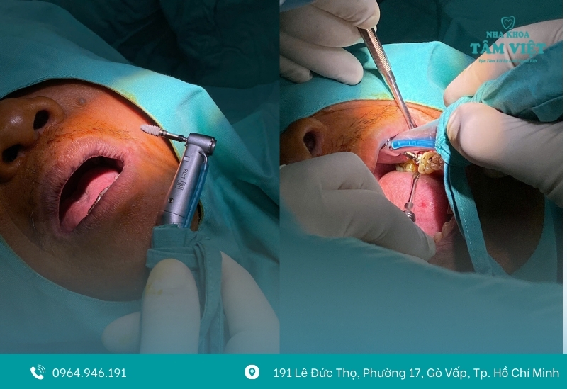 Tiêu xương hàm có trồng implant được không?
