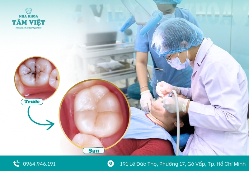 Miếng trám đúng kỹ thuật bịt kín ổ sâu, ngăn mùi hôi hiệu quả