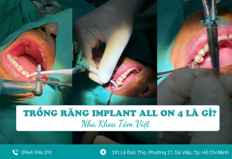 Trồng răng implant all on 4 là gì? Giá bao nhiêu?