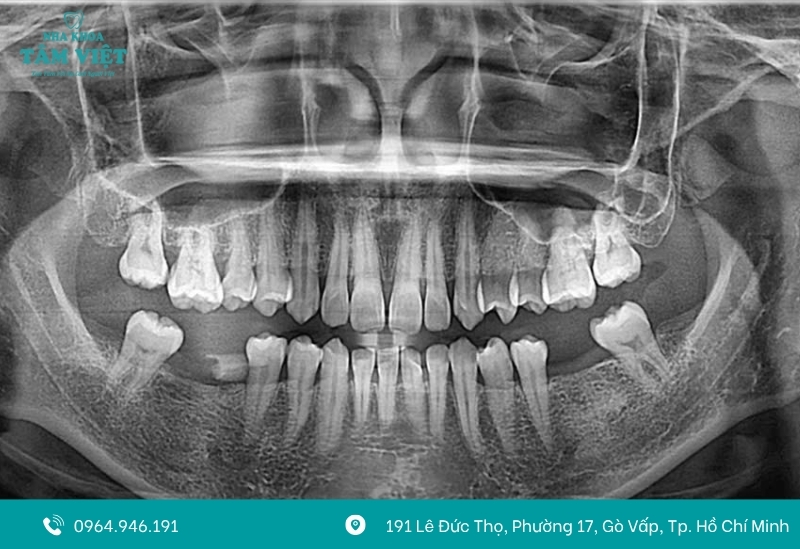 Trồng răng implant all on 4 là gì? Giá bao nhiêu? 5 Trồng răng implant all on 4 trọn gói bao gồm những gì?