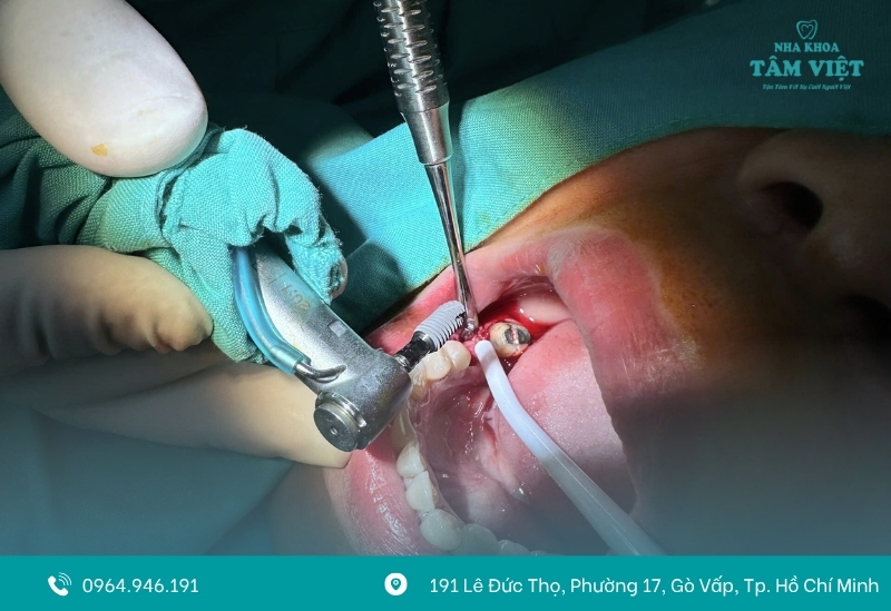 Trồng răng implant cho trẻ được không? Cần lưu ý gì? 6 Trải nghiệm trồng răng Implant an toàn và không đau