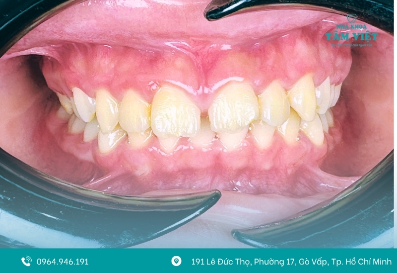 Trồng răng implant cho trẻ được không? Cần lưu ý gì? 2 Xương hàm chưa phát triển hoàn thiện