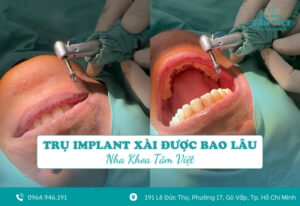 Trụ implant xài được bao lâu? Có bền không?