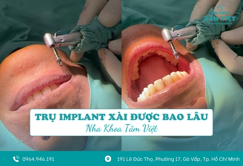 Trụ implant xài được bao lâu? Có bền không?