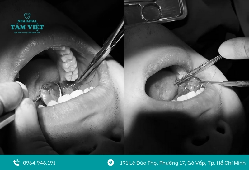 Trụ implant xài được bao lâu? Có bền không? 5 Thời gian tích hợp xương trung bình từ 3 đến 6 tháng