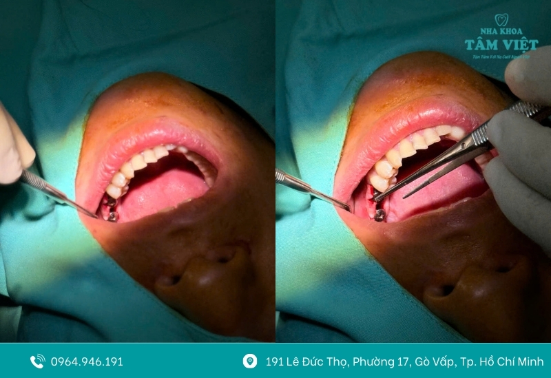 Trụ implant xài được bao lâu? Có bền không? 8 Quy trình cấy ghép Implant chuẩn Y khoa