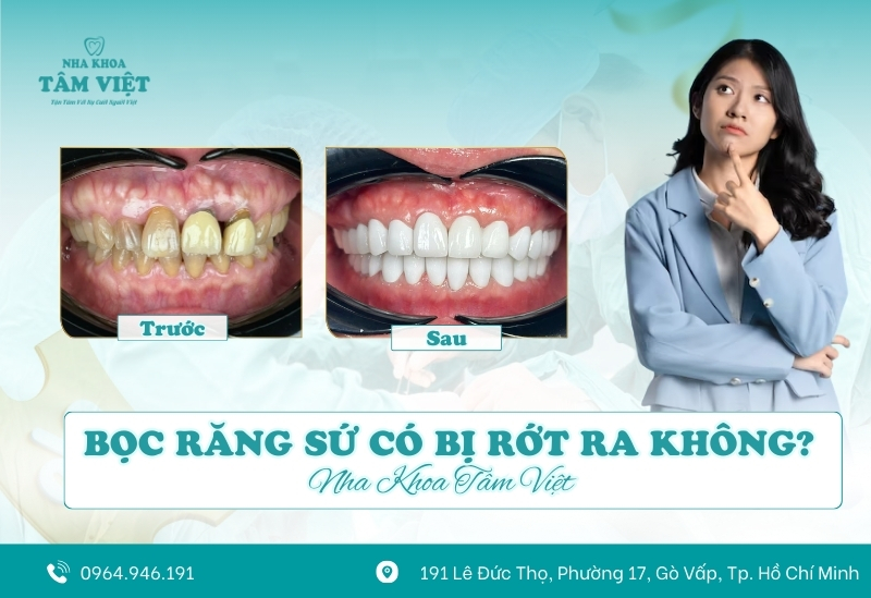 Bọc răng sứ có bị rớt ra không? Cách khắc phục