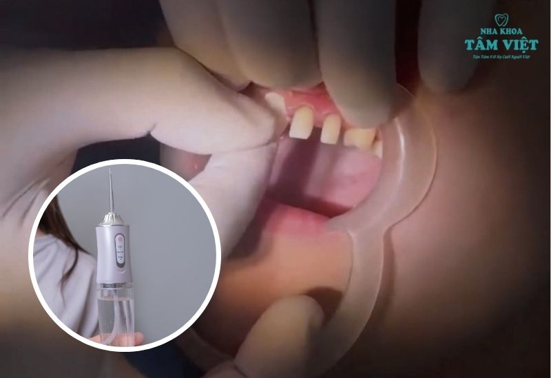 Bọc sứ nên sử dụng máy tăm nước
