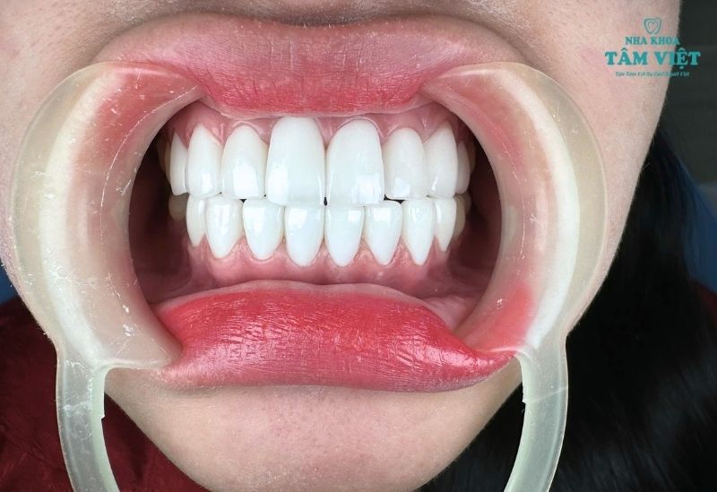 Tăm nước vệ sinh kẽ răng hiệu quả