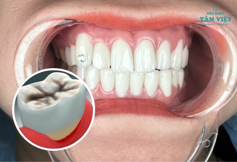 Bọc sứ răng sâu an toàn