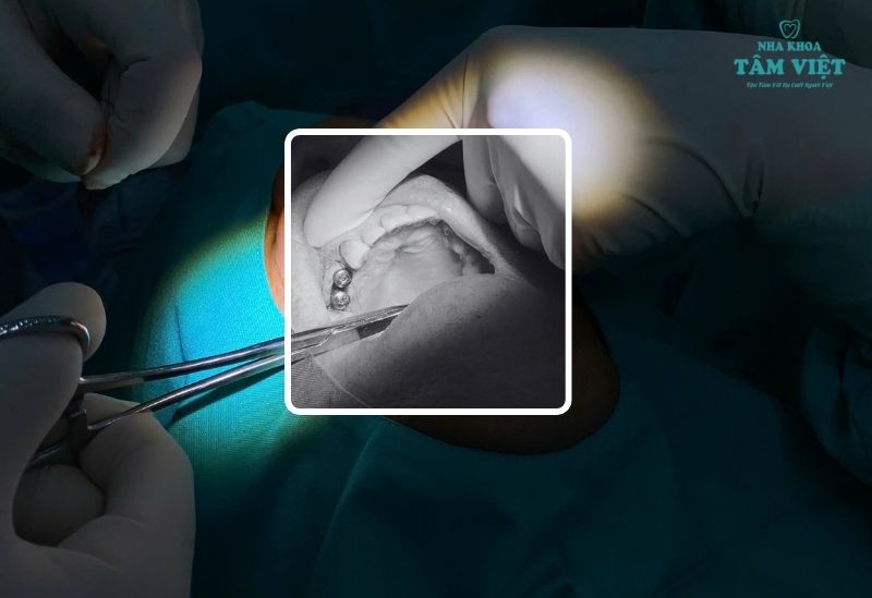 Địa chỉ trồng răng implant an toàn