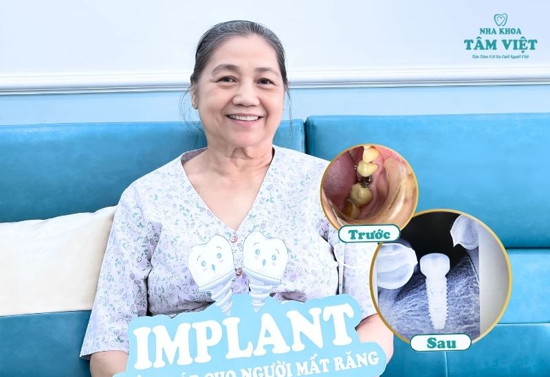 Khách hàng lớn tuổi trồng răng implant an toàn