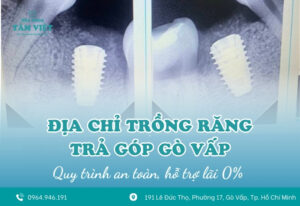Địa chỉ trồng răng trả góp Gò Vấp chất lượng, hỗ trợ lãi 0%