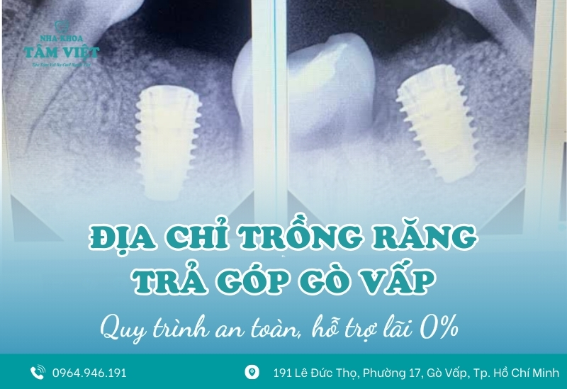 Địa chỉ trồng răng trả góp Gò Vấp chất lượng, hỗ trợ lãi 0%