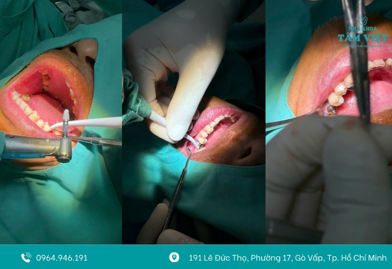 Quy trình trồng răng Implant trả góp tại Nha khoa Tâm Việt