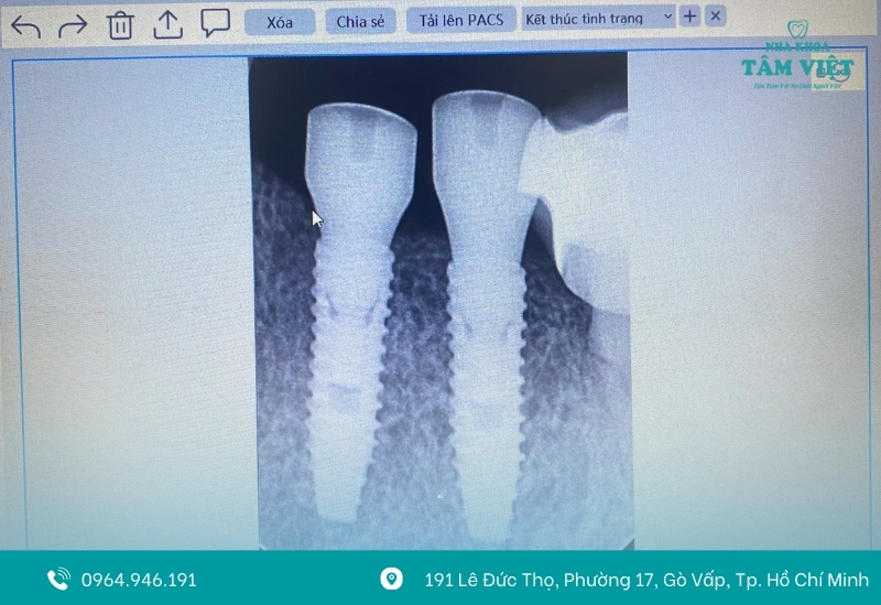 Trụ Implant chính hãng, chất lượng