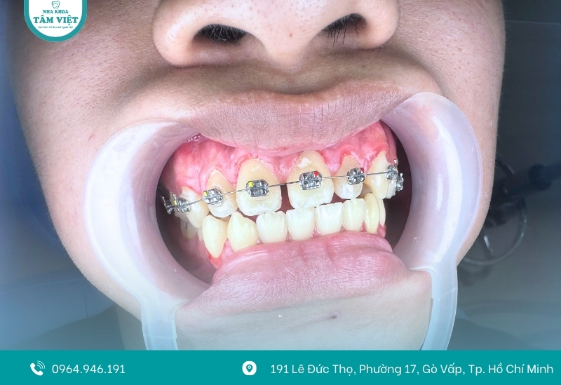 Các yếu tố ảnh hưởng đến giá niềng răng là bao nhiêu