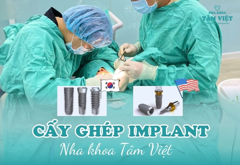 implant Hàn Quốc hay implant Mỹ