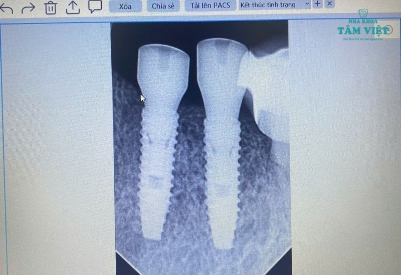 Hình ảnh trụ implant được cắm vào xương hàm