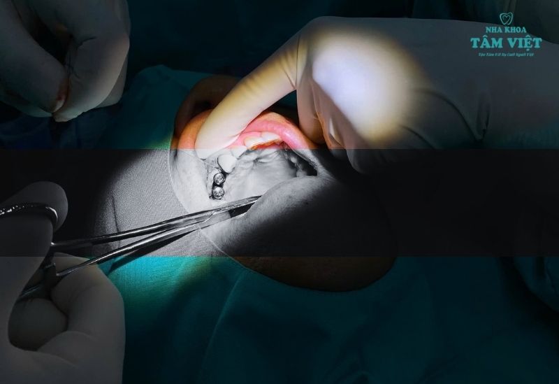 Hình ảnh cấy ghép thực tế tại Tâm Việt