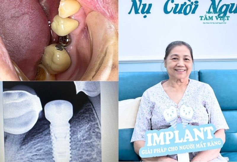 Khách hàng trồng implant tại Tâm Việt