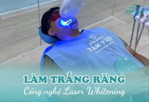 làm trắng răng Laser Whitening